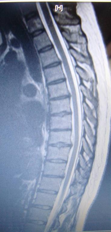 thoracic disc herniation treated by Georgetown chiropractor